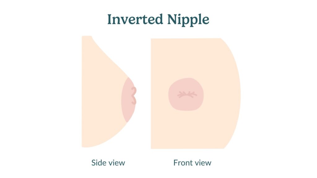 Inverted Nipples: Causes and When to Seek Advice